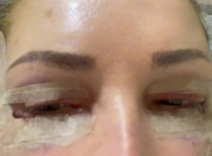 Nina (65) odlučila se za PLASTIČNU operaciju u Turskoj: Žena je sada pokazala šta ju je zadesilo (VIDEO)