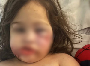 Devojčica (3) je samo želela psa: Roditelji su udomili PITBULA, a onda je usledila DRAMA - Dete više nikada neće moći da se NASMEJE