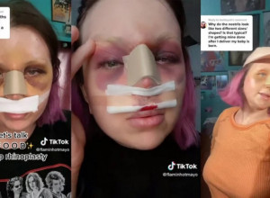 Posle estetskog zahvata usledio je PAKAO: Želela je samo da bude LEPA, a sada prolazi kroz strahotu