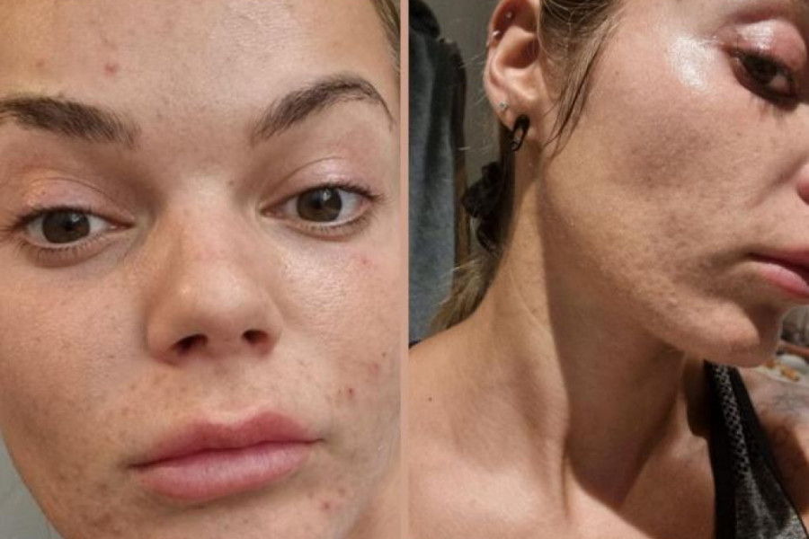 Sara je mučila muku sa BOLNIM aknama: Odlučila je i izbacili ovo iz ISHRANE i njeno lice se OPORAVILO