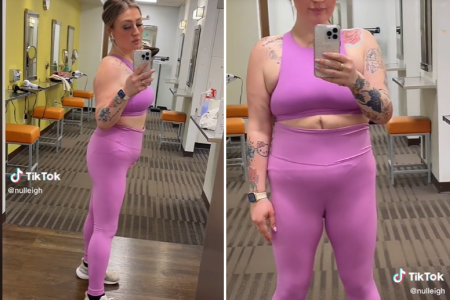 Nakon što je smršala 90 kilograma, otišla je na OPERACIJU: Viktorija se šokirala kada je videla svoj ISKASAPLJENI stomak