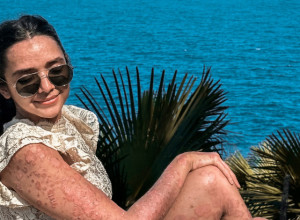 Više od 95 % njenog tela je pokriveno psorijazom: Ona sa ponosom pokazuje svoje telo, jer ona nije njeno oboljenje!