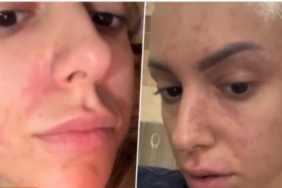 "Pojela sam sladoled i završila u Urgentnom na infuziji": Katarina je dobila osip po celom telu