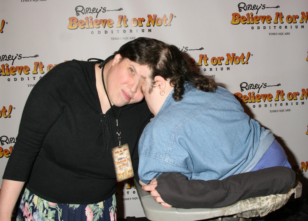 Sijamska bliznakinja tvrdi da živi normalan život: "Izlazim sa muškarcima"