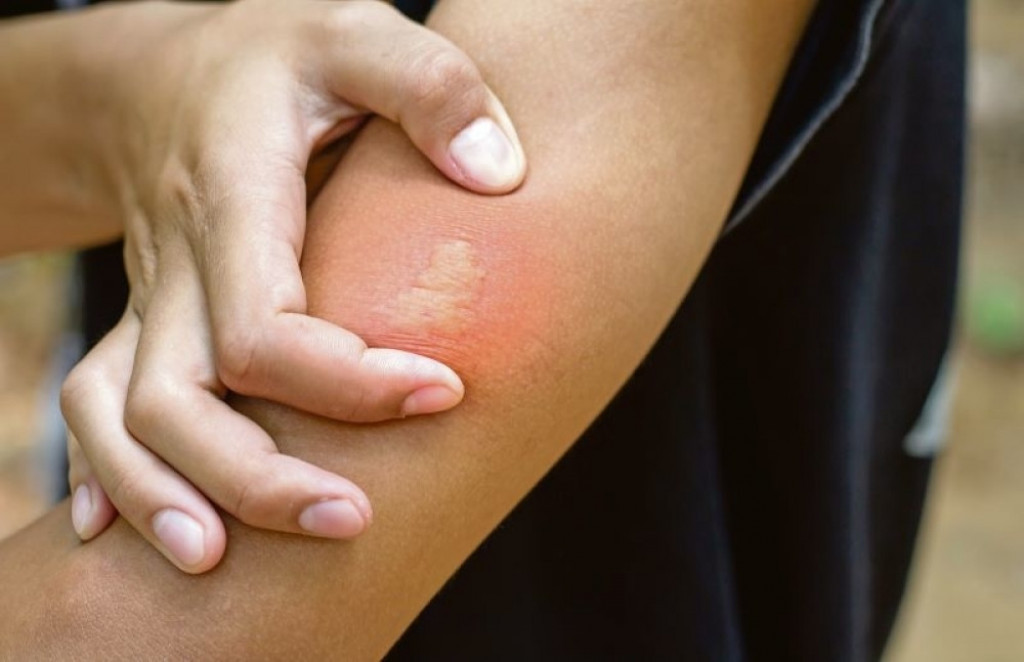 Samo ovo stavite na mesto uboda: Spas kada vas ujedu pčela, osa ili stršljen