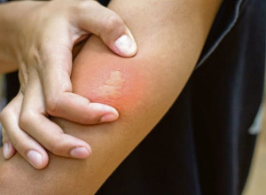 Samo ovo stavite na mesto uboda: Spas kada vas ujedu pčela, osa ili stršljen