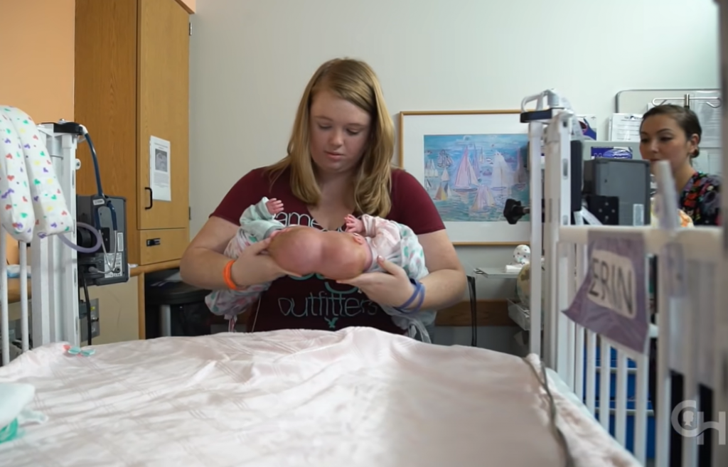 Rođene su sa spojenim glavama: Imale su samo dva posto šanse da prežive, a evo kako danas život devojčica izgleda