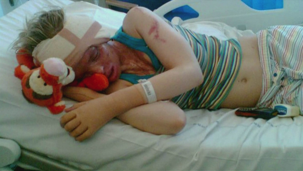 Dečko ju je osam sati silovao, pa polio kiselinom: U agoniji, s istopljenim licem, trčala je ulicom - Evo kako izgleda nakon 400 operacija