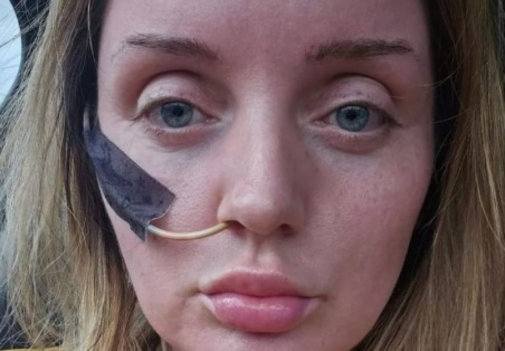 Do kraja života ješće na cevčicu: Devojka u Turskoj preživela pakao, za bolji izgled umalo platila glavom jer se  "doktor zaneo"