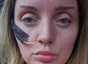 Do kraja života ješće na cevčicu: Devojka u Turskoj preživela pakao, za bolji izgled umalo platila glavom jer se  "doktor zaneo"