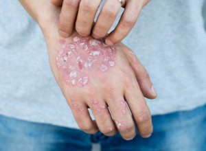 Svetski dan borbe protiv psorijaze: Kožno oboljenje koje ima i Kim Kardašijan, ne leči se, ali se može značajno ublažiti