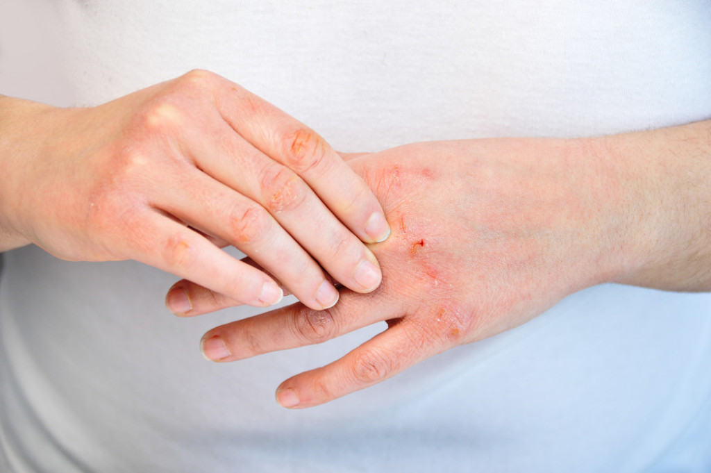Šta izaziva atopijski dermatitis? Ovo su najveći okidači, izbegnite ih pre nego što bude prekasno