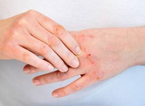 Šta izaziva atopijski dermatitis? Ovo su najveći okidači, izbegnite ih pre nego što bude prekasno