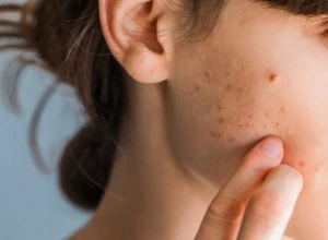 Akne obožavaju ovu hranu: Izbegavajte je ako želite lepo i čisto lice, provocira lučenje sebuma