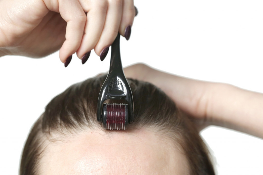 Šta je "microneedling"? Inovativna procedura obećava sprečavanje gubitka kose, evo šta treba da znate pre nego što isprobate