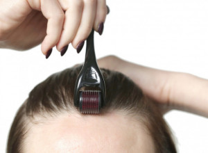 Šta je "microneedling"? Inovativna procedura obećava sprečavanje gubitka kose, evo šta treba da znate pre nego što isprobate