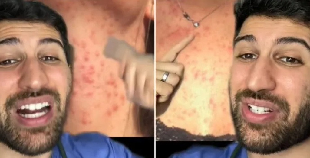 Devojci je koža bila uništena: Doktor otkrio koji predmet iz kozmetičke torbice je uzrokovao osip po telu koji je jedva izlečila