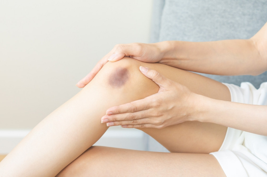 Da li su modrice opasne? Najčešći razlozi za njihovu pojavu po telu, evo kada treba da se javite lekaru