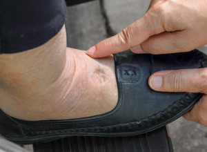 Otiču vam ruke, noge i lice? Moguće je da imate jednu od ovih bolesti