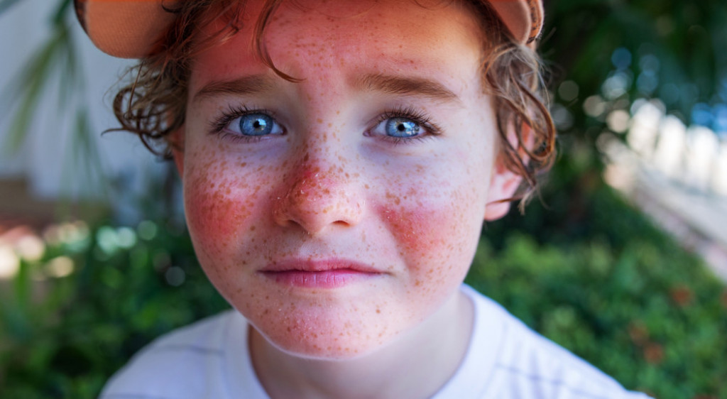 Hidratacija je ključna: Evo kako da se rešite užasnog svraba i opekotina od sunca