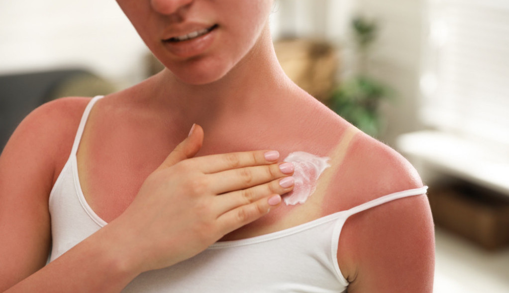 "Izgorela sam na suncu, a svekrvin trik me spasio za pola sata": Fora je u proizvodu koji svi imamo kod kuće, a nije kiselo mleko