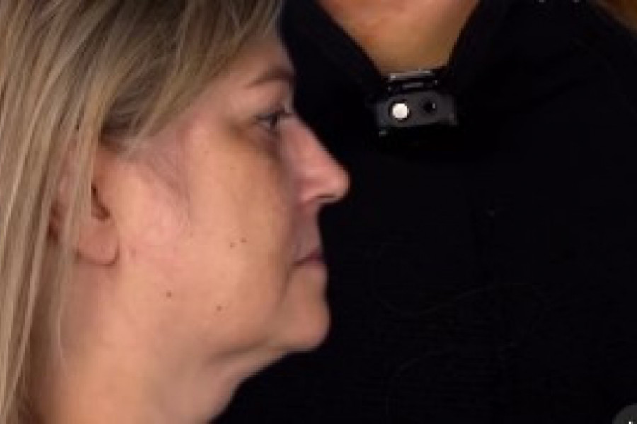 Sa 52 godine, Lana je želela da ponovo izgleda kao sa 18: Hirurgu je donela jednu jedinu fotografiju. Pogledajte njen novi izgled (UZNEMIRAVAJUĆI VIDEO)