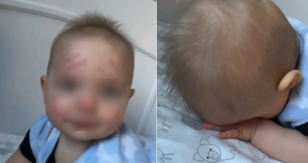 Majka na bebinom licu zatekla crvene tragove: Ono šta je otkrila svi komentarišu