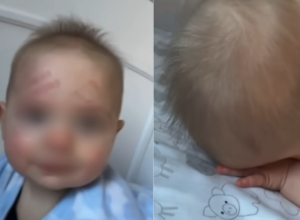 Majka na bebinom licu zatekla crvene tragove: Ono šta je otkrila svi komentarišu