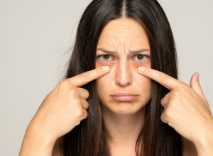 Imate tamne podočnjake? Oni mogu biti simptom ove bolesti, nisu samo posledica umora