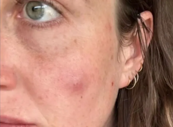 Mislila je da ima običnu bubuljicu, ali ona se povećavala: Na kraju je završila na operaciji i sa 30 šavova na licu