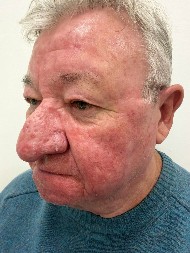 Nije mogao da poljubi ženu, niti da jede i pije normalno: Penzioneru odjednom narastao nos, a ovo su simptomi retke bolesti koja ga je snašla