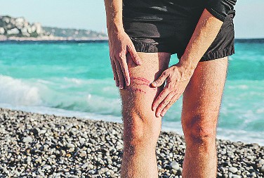 Da vam se letovanje ne pretvori u horor: Evo šta da radite ako stanete na ježa ili vas opeče meduza