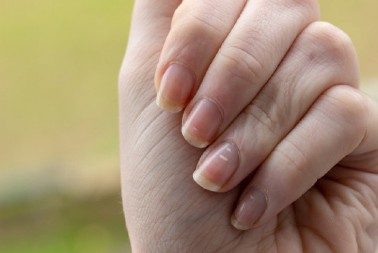 I nokti na nogama mogu da otkriju bolest: Ako primetite ove promene, moguće je da vas je napao „tihi ubica“