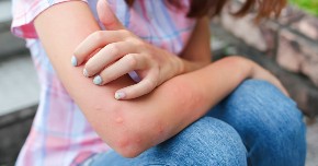 Komarci najviše napadaju ljude sa ovom krvnom grupom: Još ako pijete ovo piće, ima da vas urnišu