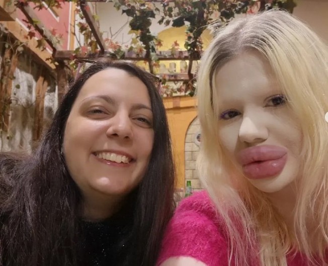 Bugarka sa NAJVEĆIM USNAMA na svetu otkriva zašto NE MOŽE da stane: Pogledajte kako je Andrea Ivanova nekada izgledala pre estetskih operacija