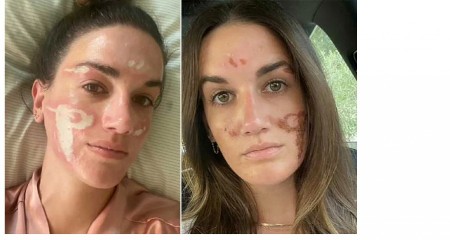Spaljivala mi je lice, vrištala sam od bolova! Poznata kozmetičarka me unakazila, pazite gde idete, ožiljci ostaju zauvek
