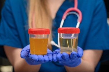 Proverite urin: Miris otkriva više nego što mislite, jedna promena može biti znak za uzbunu