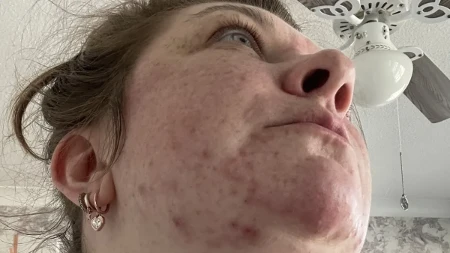 Zbog akni je preživela pakao, smejali joj se i vređali je, a ona... Žena pronašla rešenje za sitne pare, rešila se problema zauvek