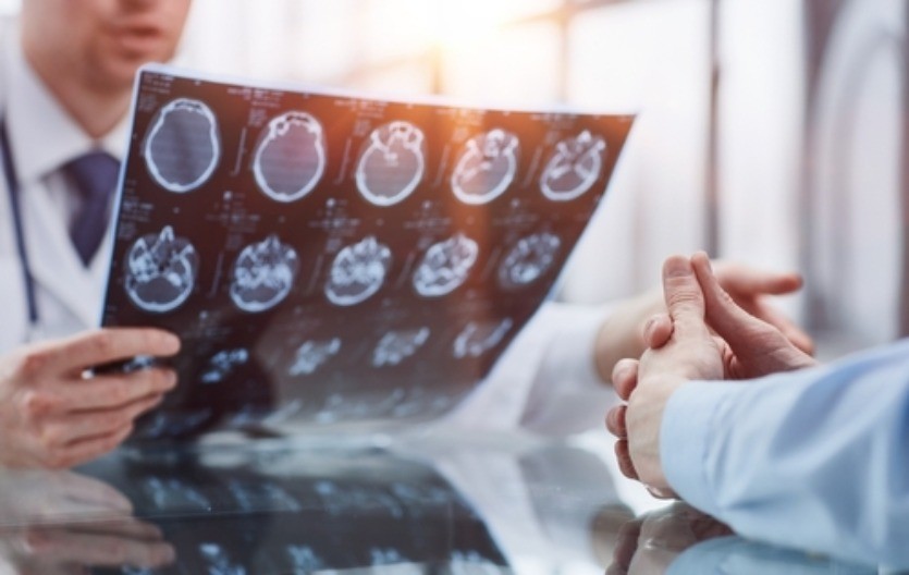 2 rana znaka raka mozga: Ove simptome niko ne povezuje sa tumorom, a trebalo bi