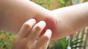 Evo kako da prepoznate koji insekt vas je ujeo: Ako primetite ovo, odmah kod lekara!