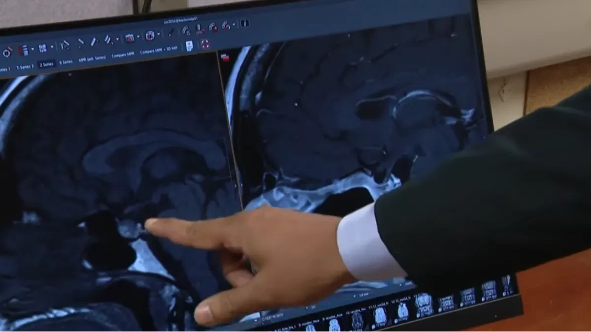 Mislila da je do stresa: Česti simptomi krili su opaku bolest, a ona kaže da je ovo bio najgori deo