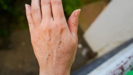 Imamo rešenje za fleke na rukama: Sami napravite domaću kremu od koje se koža preporodi
