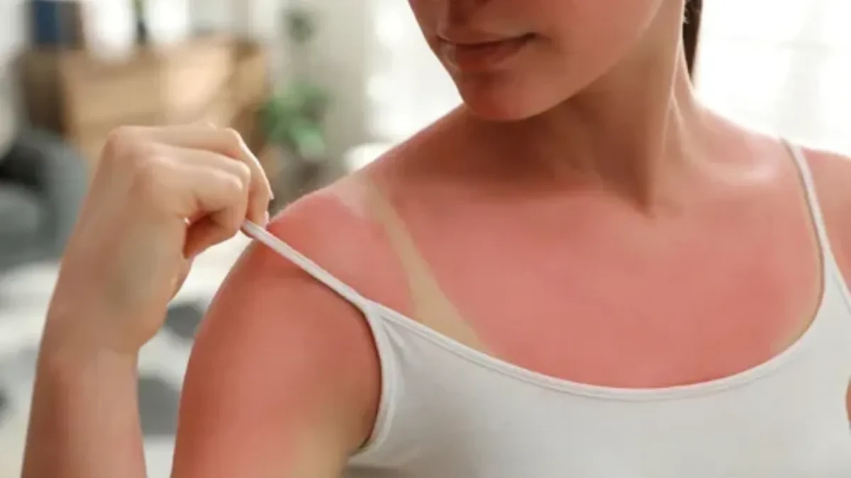 Užasno sam izgorela na suncu: Komšinica mi je dala recept i sutradan sam bila kao nova!