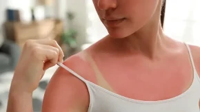Užasno sam izgorela na suncu: Komšinica mi je dala recept i sutradan sam bila kao nova!