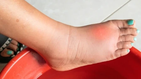 Otiču vam noge od vrućine? Evo šta da sipate u lavor i osećaj tereta nestaje