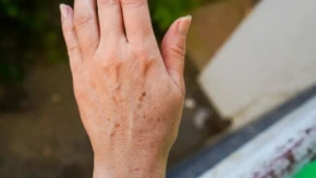 Imamo rešenje za fleke na rukama: Sami napravite domaću kremu od koje se koža preporodi