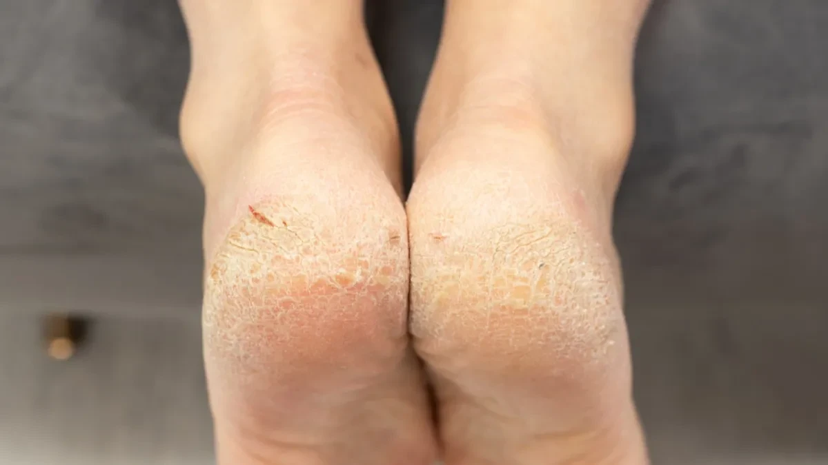 Došlo vreme za sređivanje pred zimu: Kako skinuti "mrtvu kožu" sa peta, biće mekane kao bebina koža